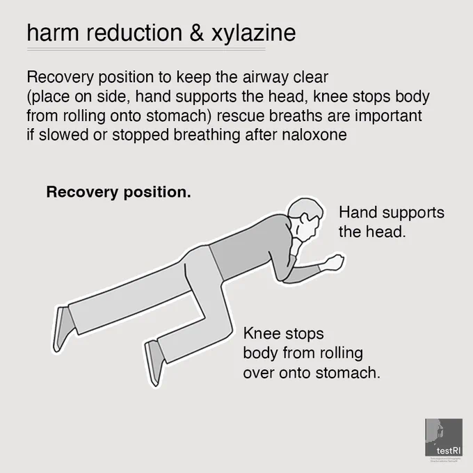 Harm Reduction & Xylazine

* Recovery position to keep the airway clear (place on side, hand supports the head, knee stops body from rolling onto stomach) rescue breaths are important if slowed or stopped breathing after naloxone

[Image of someone in the recovery position. Laid down with their hand supporting their head and knees stopping their body from rolling over on to their stomach]