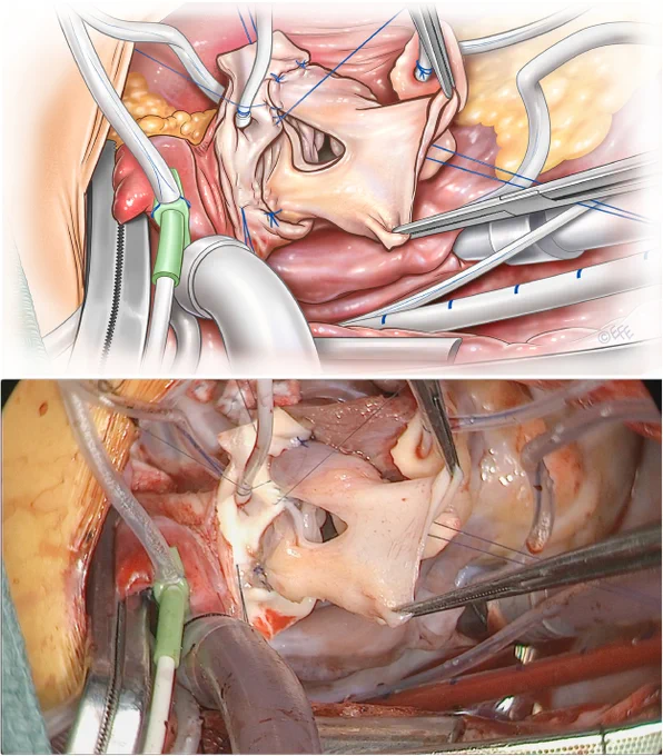 Implantation of the left coronary artery. The left coronary artery is left in situ and implanted into the autograft. Leaving the left coronary artery in its native position eliminated the risk of coronary artery distortion.