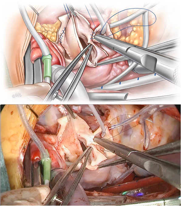 Implantation of the right coronary artery. The incision is made in the middle of the corresponding sinus of the autograft. The right coronary artery is implanted so that the edges of the autograft are connected to each other above the coronary button to avoid inadvertent enlargement of the sino-tubular junction.