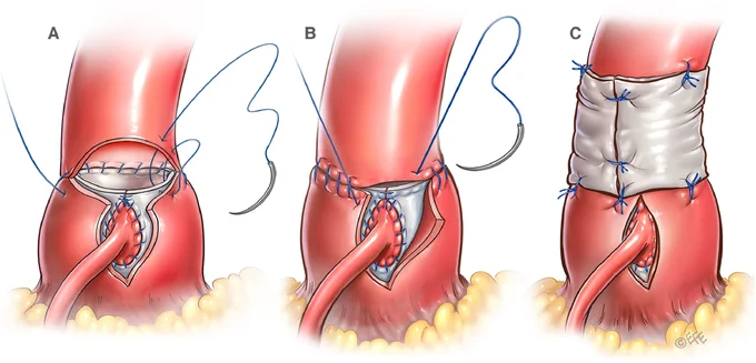 Reconstruction and stabilization of the aortic root. The posterior wall of the autograft is sutured to the undivided posterior wall of the native aorta (A). The anterior wall of the autograft is sutured incorporating all 3 layers (i.e., autograft and the edges of the native aorta) into the suture line (B). The suture line at the sino-tubular junction is covered and reinforced with a strip of the autologous pericardium (C).