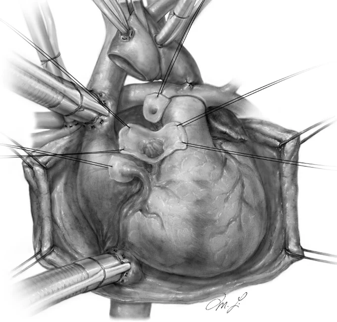 Removal of aortic valve and evaluation of the left ventricular outflow tract.