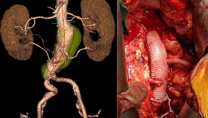 jr-AAA w/ anomalous renal arteries, sure it could have been done endo, but for this 60 yo healthy patient, open repair was the way (w/ written consent)