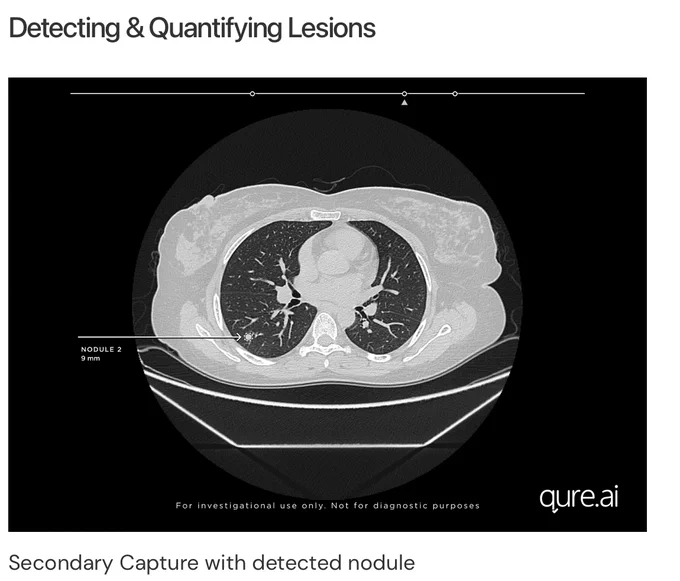 qure.ai lung cancer detection