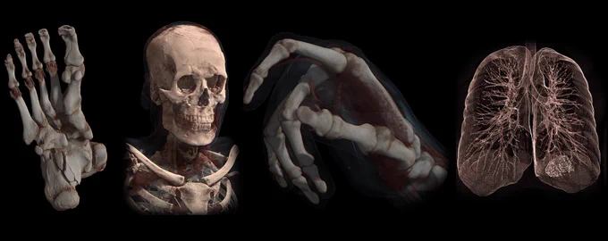 A picture depicting different photorealistic 3D renders of a foot, skull, hand and lungs made with Horos Mobile for Mac