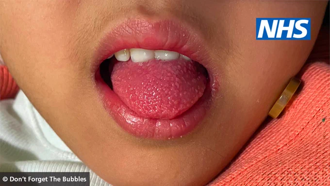 Child with medium brown skin with a red, swollen tongue covered in little bumps (called "strawberry tongue").
