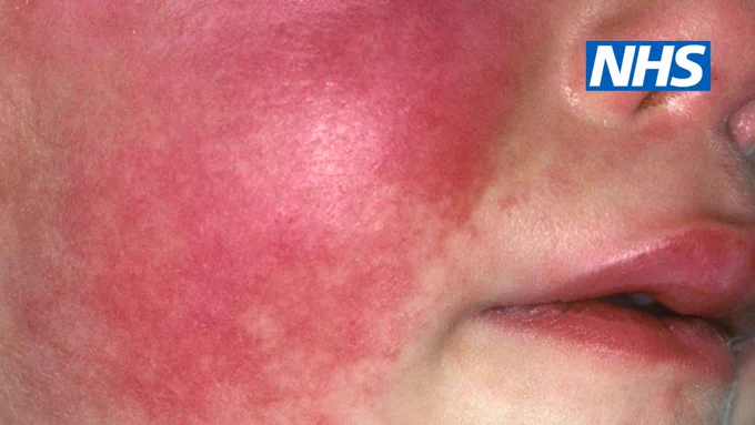 Child with white skin with a rash on their face. The rash appears red and pink.