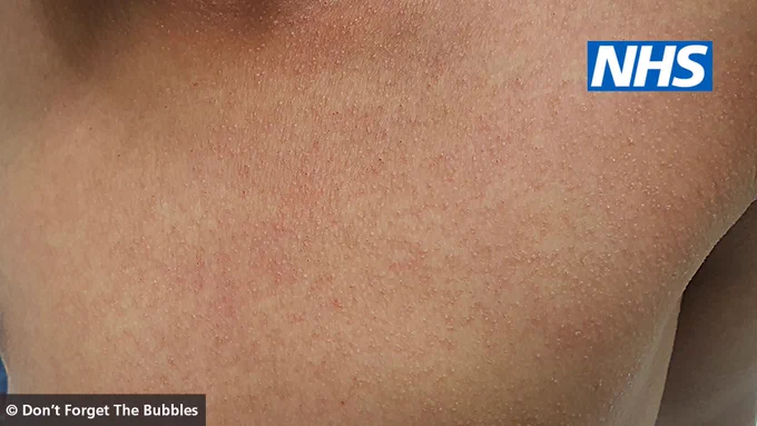 Child with light brown skin with a rash on their chest. The rash appears as raised bumps.