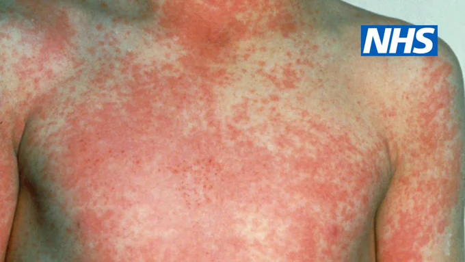 Child with white skin with a rash on their arms, neck and chest. The rash appears red and pink.
