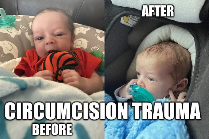 That was one normal-looking, happy baby. What happened?

29 October 2022
babygaga.com/babies-can-remember-pain-heres-the-scoop
Babies Can Remember Pain, Here's The Scoop

23 Oct
nature.com/articles/s41443-022-00619-8
Potentially under-recognized late-stage physical and psychosexual complications of non-therapeutic neonatal penile circumcision: a qualitative and quantitative analysis of self-reports from an online community forum

8 Oct
springer.com/article/10.1007/s00406-022-01495-5
Psychological trauma as a transdiagnostic risk factor for mental disorder: an umbrella meta-analysis

Updated July 2022, with 48 references
doctorsopposingcircumcision.org/for-professionals/psychological-impact/

2 Dec
nature.com/articles/s41443-022-00639-4
Child genital cutting and surgery across cultures, sex, and gender. Part 1: female, male, intersex—and trans? The difficulty of drawing distinctions
IntactAmeric.org
DoctorsOpposingCircumcision.org
YourWholeBaby.org
SavingOurSons.org