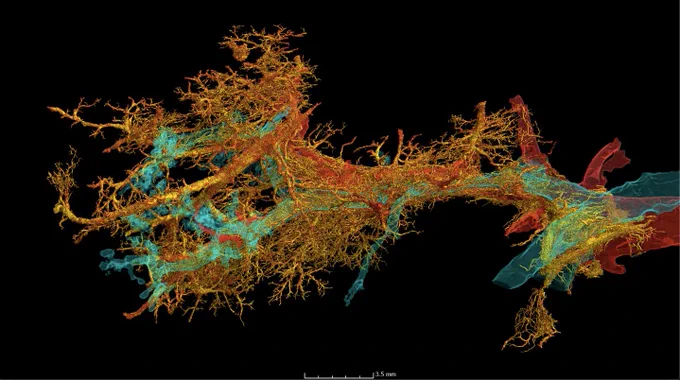 HiP-CT imaging of a Covid-19 injured lung lobe