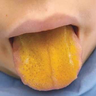 Icteric tongue