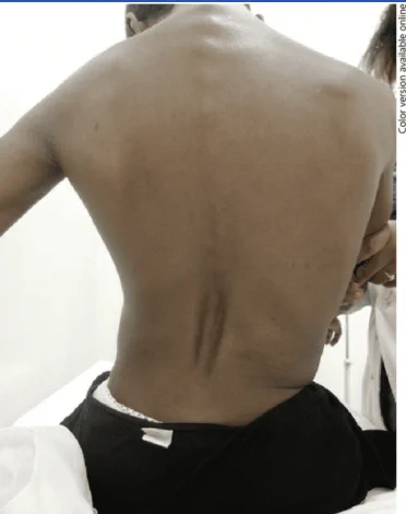1st case identified of stiff person syndrome in Tanzania