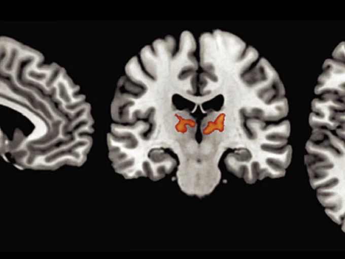 Black and white image of a brain scan with orange highlights.