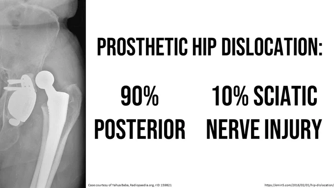 With prosthetic hip dislocations, 90% are posteriorly displaced and 10% have a sciatic nerve injury. Important to know!