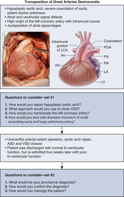 Questions to consider in the management of a rare patient with transposition of great arteries and dextrocardia. PDA, Patent ductus arteriosus; LCA, left coronary artery; Ao, aorta; PA, pulmonary artery; RV, right ventricle; RA, right atrium; LA, left atrium; LV, left ventricle; VSD, ventricular septal defect; ASD, atrial septal defect.