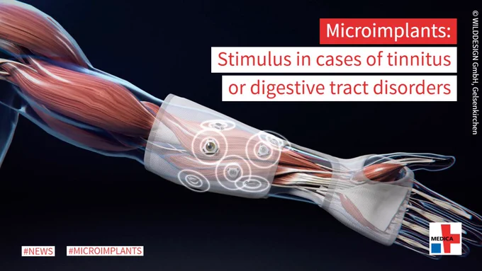 Animation of microimplants on an arm with the muscle cords visible. Text: “Microimplants: Stimulus in cases of tinnitus or digestive tract disorders.” Copyright: WILDDESIGN GmbH, Gelsenkirchen