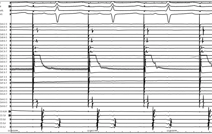 High output pacing