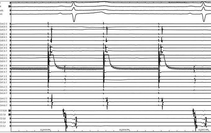 Low output pacing