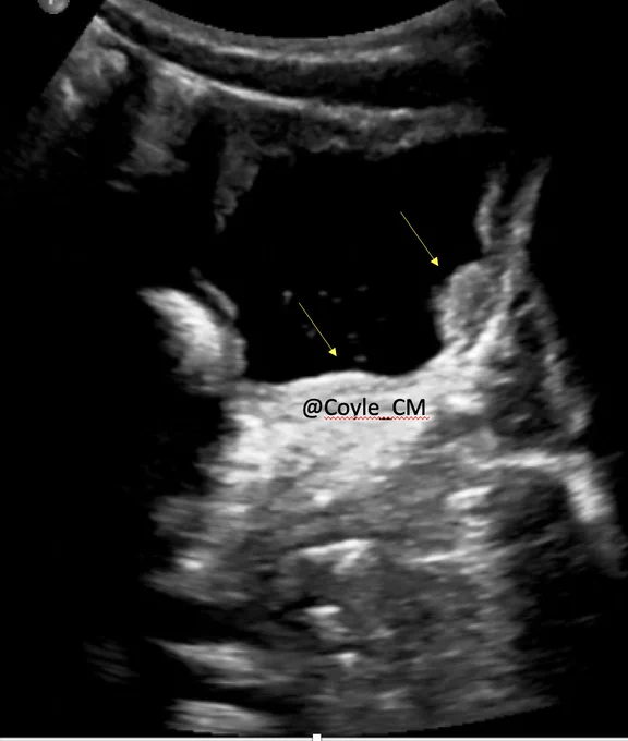 Ultrasound bladder foci of nodular thickening 1.6x.6 and 1.5 x.5 cm No hydronephrosis