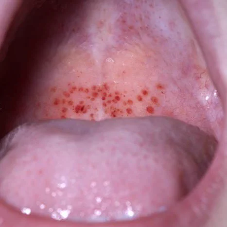 Petechiae of the palate
