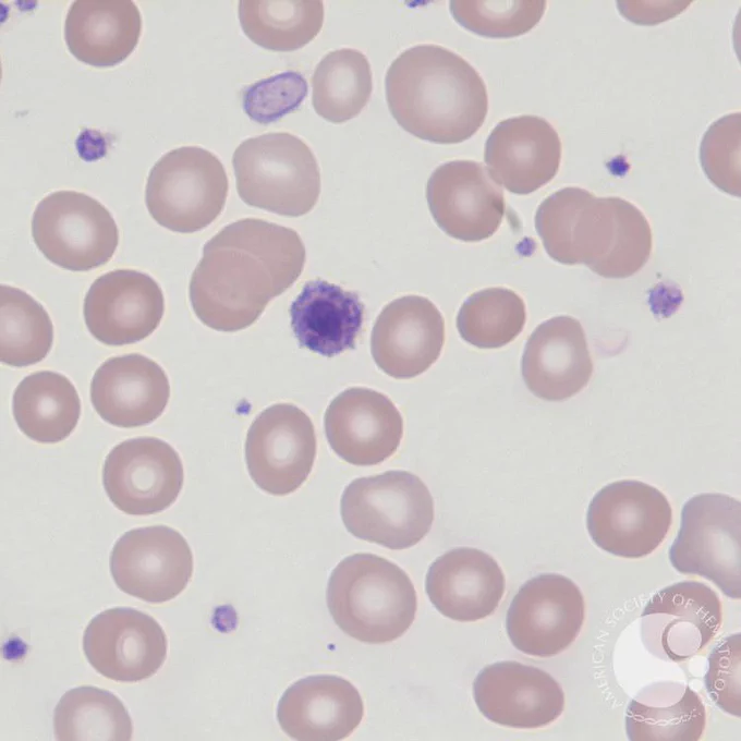 One giant platelet, two large platelets, and three normal platelets