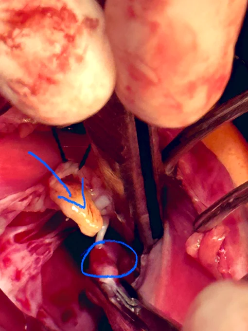 Papillary muscle head rupture