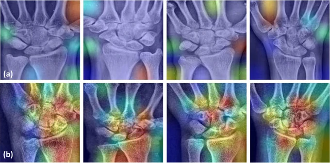 Gradient-weighted class activation map (Grad-CAM) samples for control (a) and fracture (b) cases.