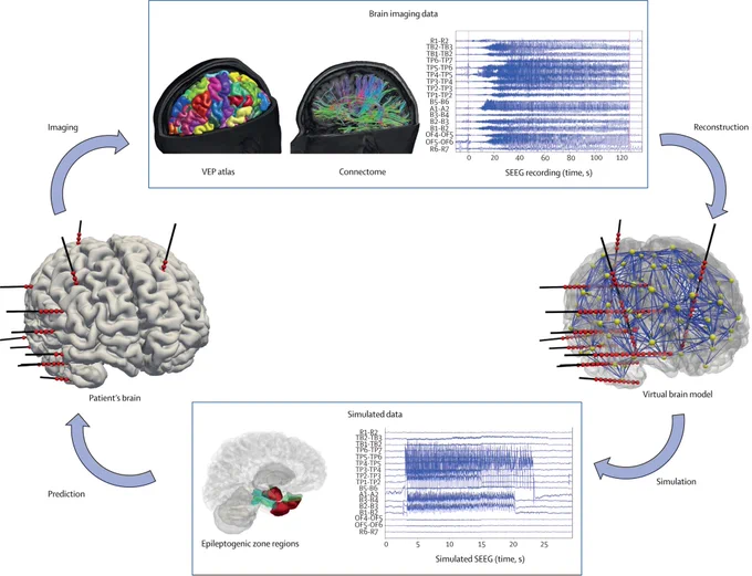 Modelling and inference workflow of the Virtual Epileptic Patient