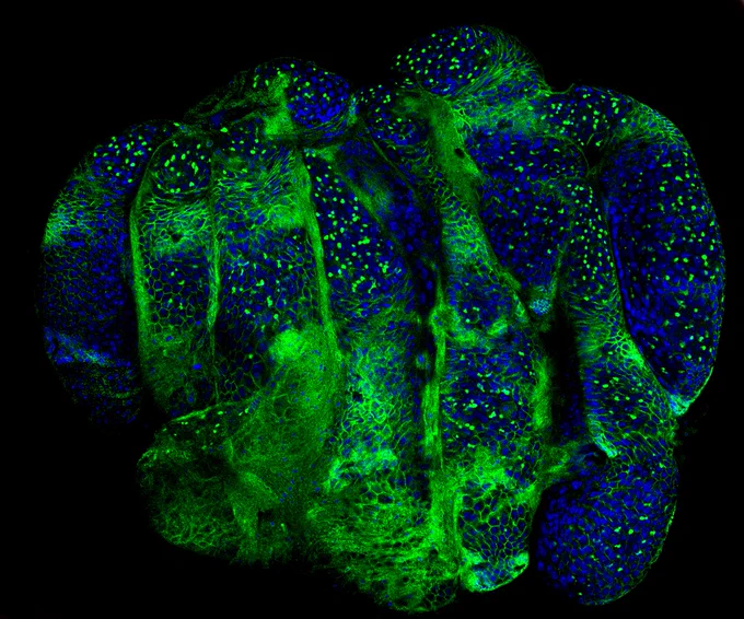 ‘Malicious Malignancies’  ​

Developing gametes rely on the careful division and differentiation of germ cells. Unfortunately, when precision fails, catastrophe occurs. In this image, the loss of two key proteins involved in the differentiation of germ cells has formed many ovarian tumors. Germ cells (interior blue) no longer divide and differentiate to produce an oocyte but instead continuously replicate into undifferentiated cell populations. These ovarian malignancies will never produce a healthy gamete and the next generation will likely never occur.  ​