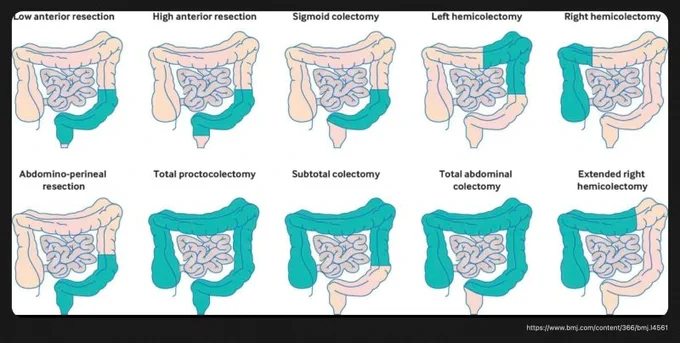 Types of Colectomies: