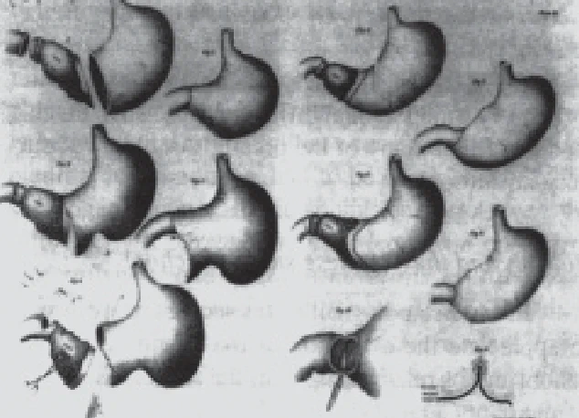 Diagram of the first stomach cancer removal surgery performed by Theodor Billroth in 1881.