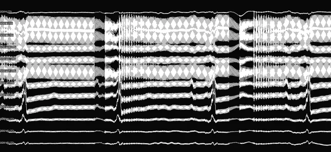 Left - 100Hz Low Pass Filter on Left; Top Right - 20Hz Low Pass Filter; Bottom right - concealed entrainment at site of termination with RF