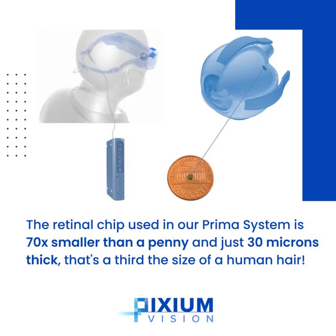 Our Prima System works by electrically stimulating the nerve cells of the inner retina in people suffering profound vision loss, which then transmit the visual information to the brain via the optic nerve. 💡

The Prima System is composed of three main elements: 
- A wireless retinal chip 
- A pair of smart glasses with a camera and digital projector 
- And a pocket patient therapy controller

The retinal chip is tiny, and can be placed by an ophthalmic surgeon. This small size and wireless design enables minimally invasive chip placement, which can be performed under general or local anesthesia.

#ophthalmology #neuroscience #eyehealth