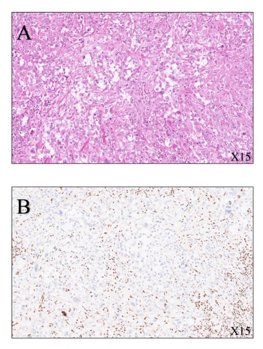 Immunohistochemistry (SMARCB1, ×15 magnification) shows loss of expression of SMARB1