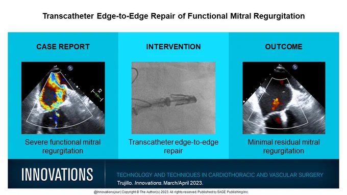 A 71-year-old man underwent transcatheter edge-to-edge repair for treatment of severe functional mitral regurgitation.
