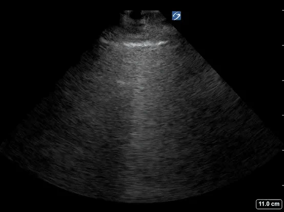 WHAT’S YOUR DIAGNOSIS? 
You are conducting a follow up visit with your 80-year-old patient who was recently admitted, and then discharged from the inpatient with the diagnosis of COVID-19 pneumonia. You review the electronic medical record from the admission and can see the lab, imaging, and consult notes. Your patient informs you that she was initially feeling good after discharge, but has started to feel fatigued and short of breath in the last 3 days since discharge. However, your patient is also quite distressed at the thought of having to potentially be readmitted to the hospital if she does not improve. As part of your evaluation, you decide to do lung ultrasound to help determine next best steps in management. 