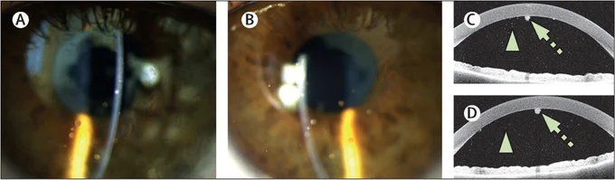 Figures showing Granulomatous anterior uveitis in early-onset sarcoidosis. Copyright: 2023 Elsevier Ltd. All rights reserved.