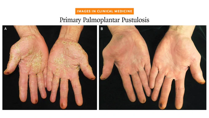 Images in Clinical Medicine
Primary Palmoplantar Pustulosis

Photos of the patient's hands at presentation (Panel A) and at the follow-up visit 1 month later (Panel B)