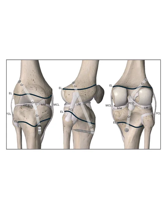 Figure depicting the transphyseal technique for anterior cruciate ligament (ACL) reconstruction. Image modified with permission courtesy of Complete Anatomy, Elsevier. EL, epiphyseal line; FCL, fibular collateral ligament; Gr, graft; LM, lateral meniscus; MCL, medial collateral ligament; MM, medial meniscus; PCL, posterior cruciate ligament.
