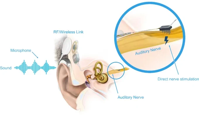 Figure 1. Concept of the auditory nerve implant (ANI) system consisting of an audio processor and cochlear implant simulator (MED-EL, Innsbruck, Austria) integrated with the ANI array (Blackrock Neurotech, Salt Lake City, Utah), which is placed directly into the auditory nerve medial to its exit from the cochlea. Image courtesy of Blackrock Neurotech and MED-EL. This schematic portrays the concept of the ANI system in which individual components are not drawn to scale or do not represent the final design that will be implanted in humans, and the placement along the nerve is expected to be closer to the cochlea within the IAC