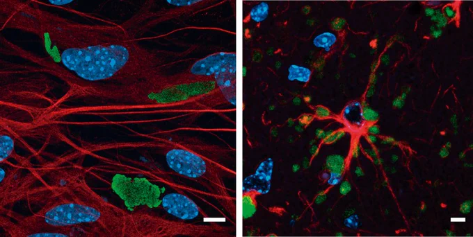 Imágenes de microscopía confocal de superresolución de dos modelos de la enfermedad de Lafora. A la izquierda, modelo celular tras 4 semanas de crecimiento en el laboratorio; a la derecha, imagen de una sección de cerebro del modelo animal de 16 meses. Detección por inmunofluorescencia de los cuerpos de Lafora (verde), astrocitos (rojo) y los núcleos (azul)./ IBV-CSIC