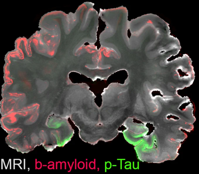 Post mortem MRI was combined with neuropathological assessments at 600 μm intervals throughout the brain. Through this approach, a three dimensional account of an entire human brain with an intermediate Alzheimer's disease neuropathologic change was created. Data were reconstructed, coaligned, and combined in a downloadable resource that allows detailed correlations between neuroimaging data and microscopy observations.