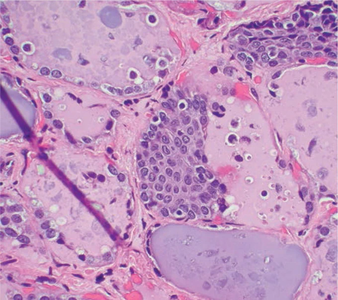 SOLID CELL NEST: The main cells of this embryonal remnant have a squamoid appearance with nuclear grooves. The latter can lead to an incorrect diagnosis of papillary microcarcinoma.
