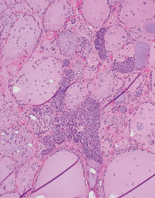 SOLID CELL NEST (SCN): At low power, this insignificant vestigial structure has a stellate appearance and can be misinterpreted as a papillary microcarcinoma.
