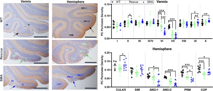 Purkinje cell (PC) degeneration is localized to posterior lobules in the cerebellum, and rescue of survival motor neuron protein expression levels in motor neurons does not ameliorate this effect. Representative images of sagittal cerebellar sections stained with anti-calbindin in the vermis and hemisphere at P12 for wild type, ChATCre  rescue (Rescue), and spinal muscular atrophy (SMA) cerebella are shown on the left. Lobules are labeled; ANCr, ansiform crus; COP, copula pyramidis. Arrows point to equivalent loci across genotypes where neurodegeneration is most prominent. PC perimeter density was calculated by dividing the PCs by the PC layer length. Scale bar = 0.5 mm.