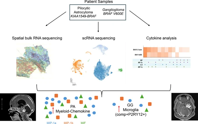 A multi pronged analysis approach revealed distinct neoplastic populations in PA and GG. Non-neoplastic populations in PA showed higher levels of immune mobilizing chemokines in PA compared to GG.