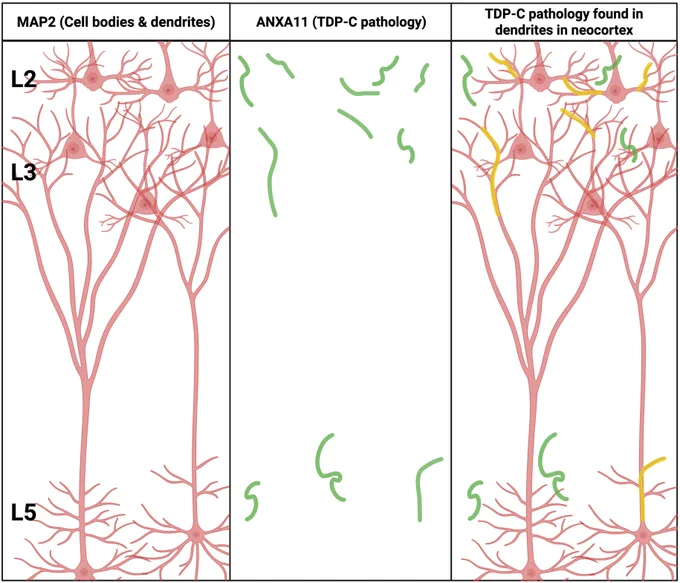The type C variant of FTLD-TDP (TDP-C) is defined by long dystrophic neurites that are immunopositive for both phosphorylated TDP and annexin A11 (ANXA11). Kawles et al. are the first paper to systematically show that these neurites are likely of dendritic origin.