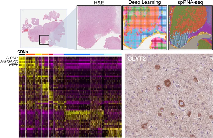 Deep learning tissue mapping can guide region of interest selection for spatial transcriptomic analyses. Using this method, a transcriptional catalogue of focal cortical dysplasia type IIb was generated, revealing enrichment for markers of inhibitory glycinergic signaling in cytomegalic dysmorphic neurons.
