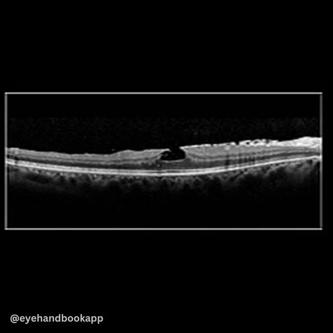 History: 78-year-old male. Left eye is normal. Right eye OCT as shown. Vision in the right eye is 20/60. Should I offer surgery or any treatment? If so, what kind of treatment? What is the prognosis?

Make your job as an eye care professional easier with the #free Eye Handbook mobile app! Access useful references, forums, clinical calculators, and information in seconds, right from your smartphone or tablet.

Available on Android & iOS — this link will automatically redirect you to the respective store based on your device:
https://www.eyehandbook.com/eyehandbook-beta/ehb_digest_post_dotnet.php?que_id=2051