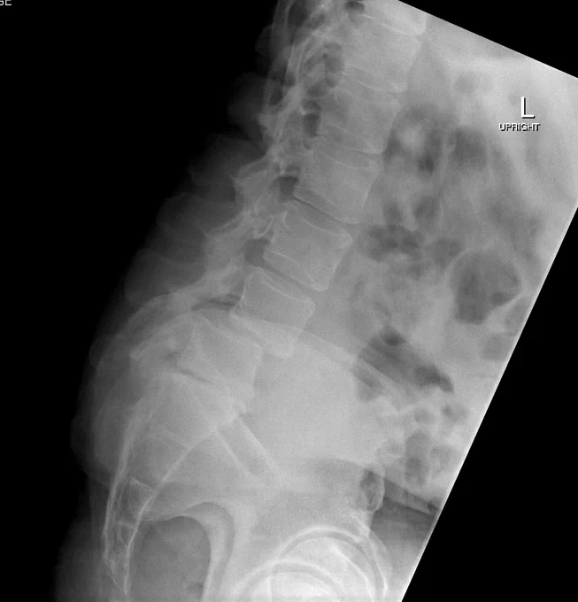 Pre op upright XR